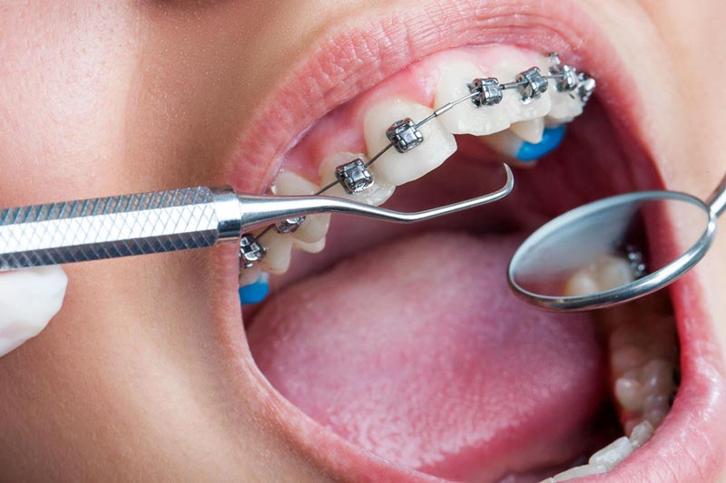 پوشش های بیمه تکمیلی البرز برای خدمات دندانپزشکی چیست؟ مراکز طرف قرارداد را از کجا پیدا کنیم؟