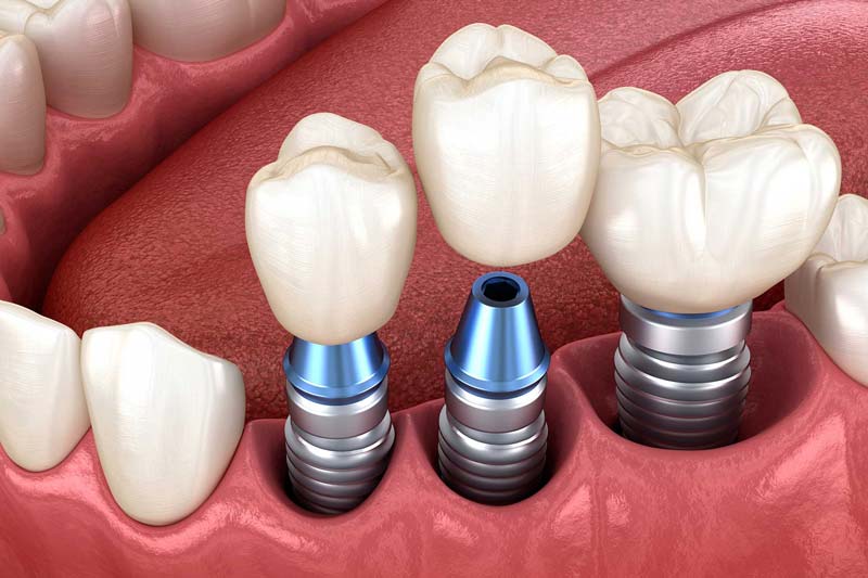 ایمپلنت دیجیتال چیست؟