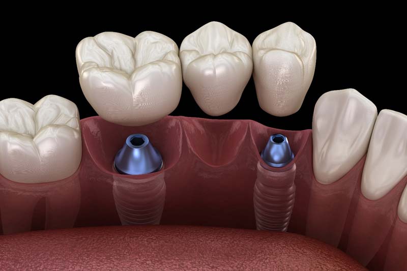 مزایا و معایب زمان های مختلف کاشت ایمپلنت چه زمانی است؟