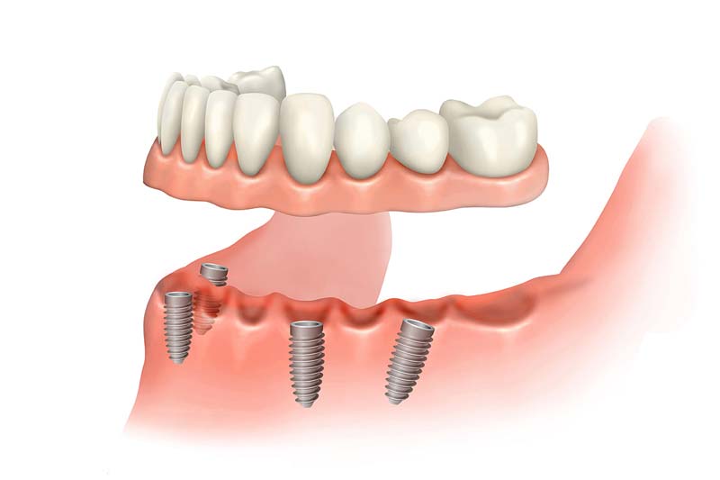 کاشت دندان بدون جراحی چگونه است؟
