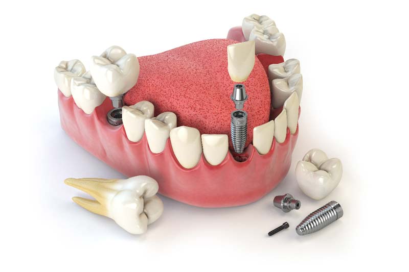 طول عمر ایمپلنت سوئیسی چه قدر است؟