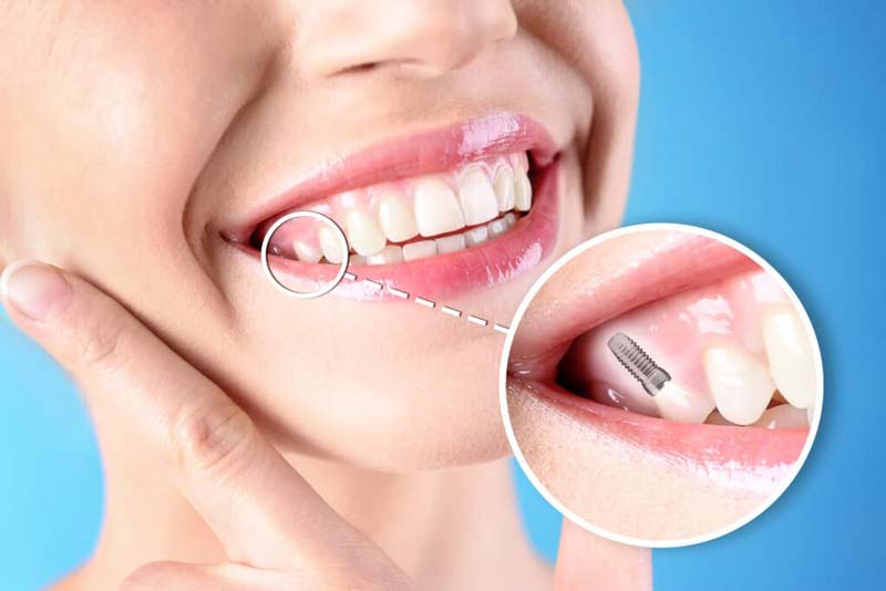 قیمت ایمپلنت کره ای