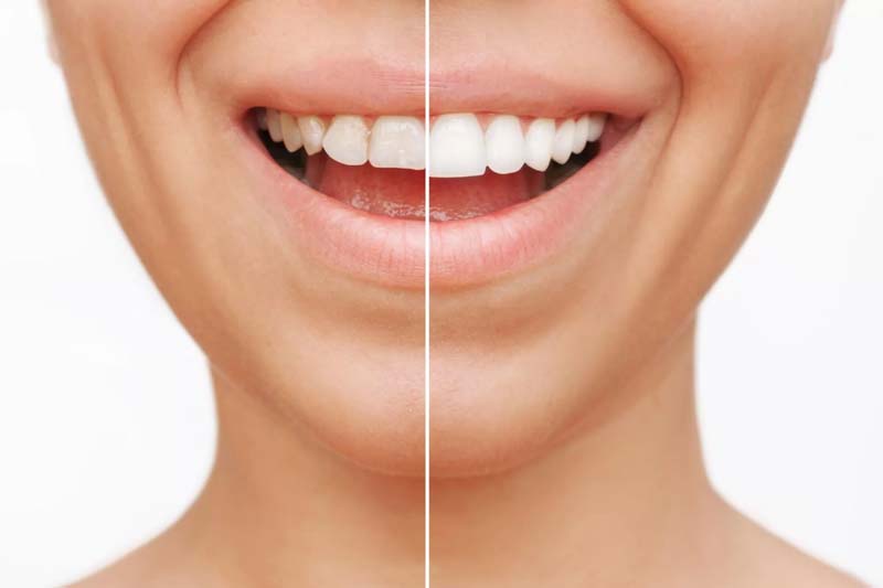 مزایا و معایب لمینت دندان چیست؟