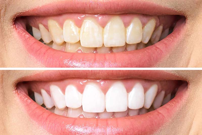هزینه بلیچینگ دندان چه قدر است؟