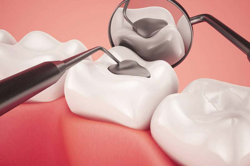 پر کردن دندان در میدان انقلاب چه مزایایی دارد؟
