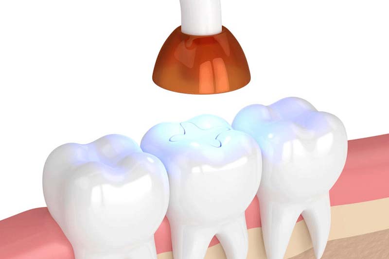 چگونه بهترین کلینیک را برای انچام کامپوزیت دندان انتخاب کنیم؟