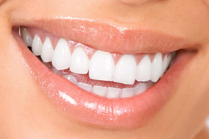 لمینت دندان چه ویژگی ها و مزایایی دارد؟