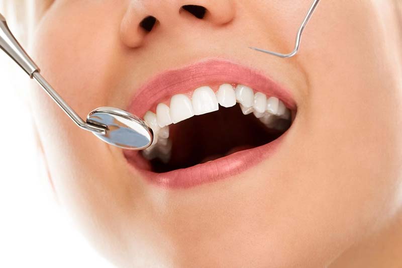 ویژگی ها و مزایا کامپوزیت دندان چیست؟