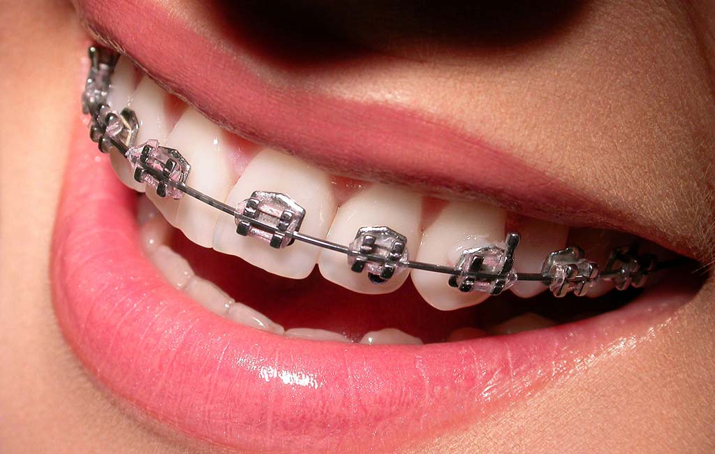 ارتودنسی تا چند سالگی جواب میده؟