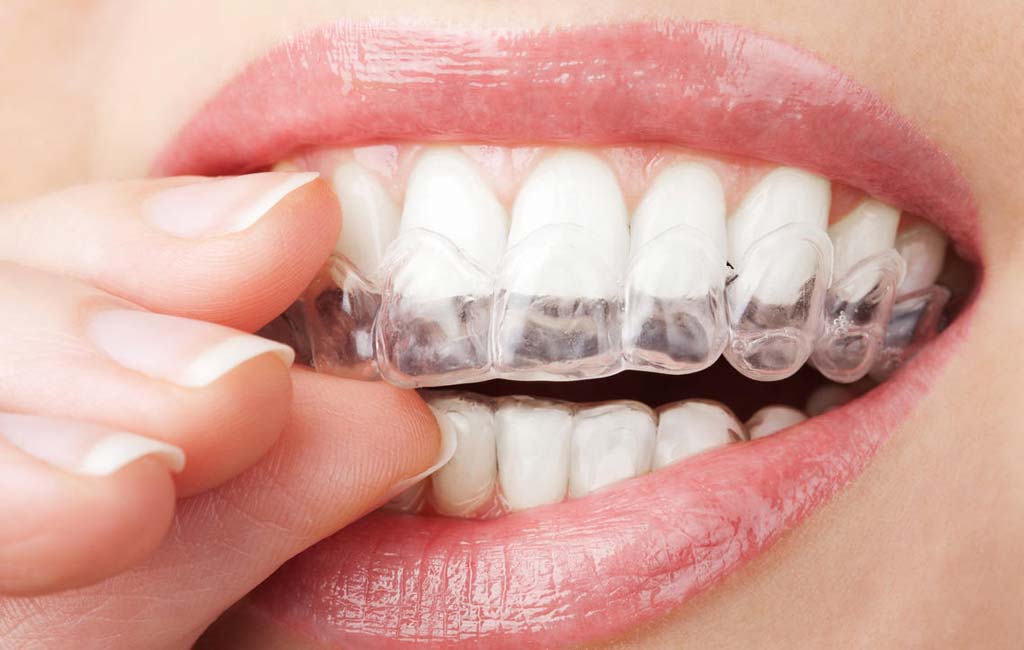 ارتودنسی نامرئی چه مزایایی دارد؟