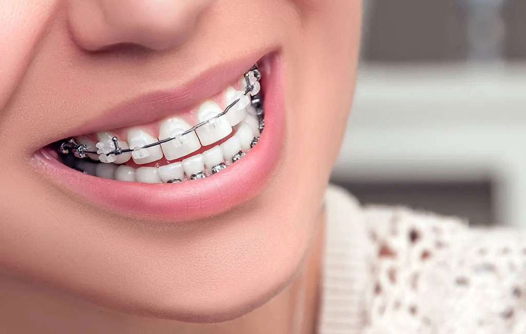 ارتودنسی با براکت سرامیکی