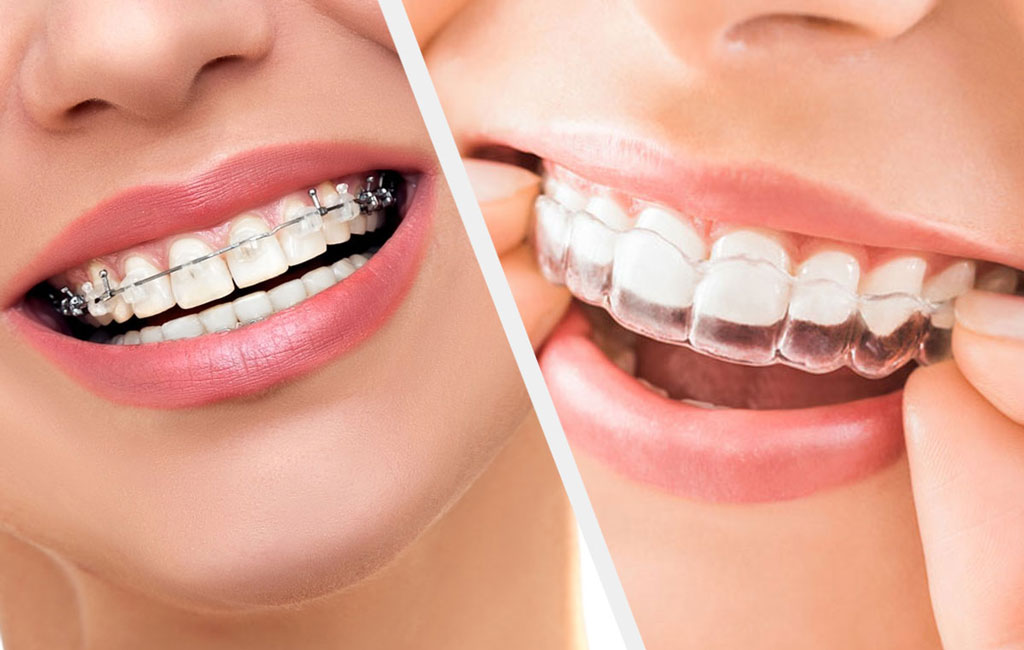 ارتودنسی ثابت و متحرک چه فرقی دارند؟ چه مراقبت هایی نیاز دارند؟