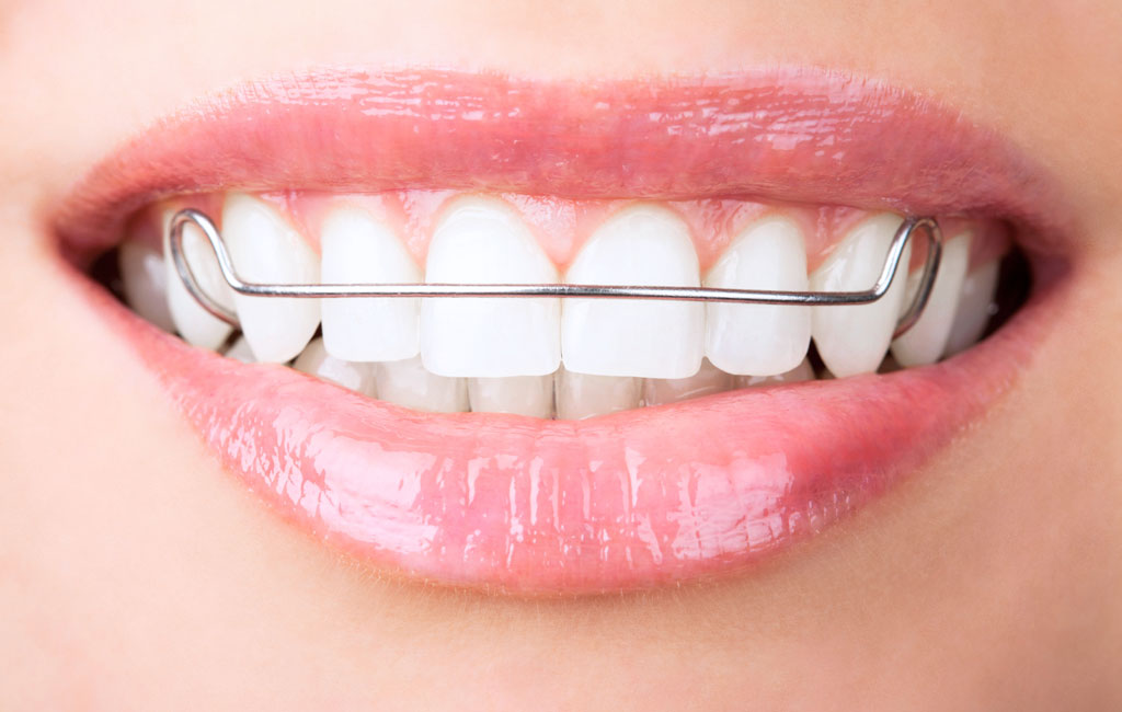 مزایا و معایب ریتینر ثابت چیست؟