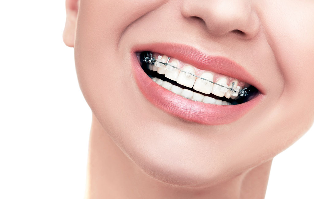 مزایا و معایب و مراحل درمان ارتودنسی سرامیکی چیست؟