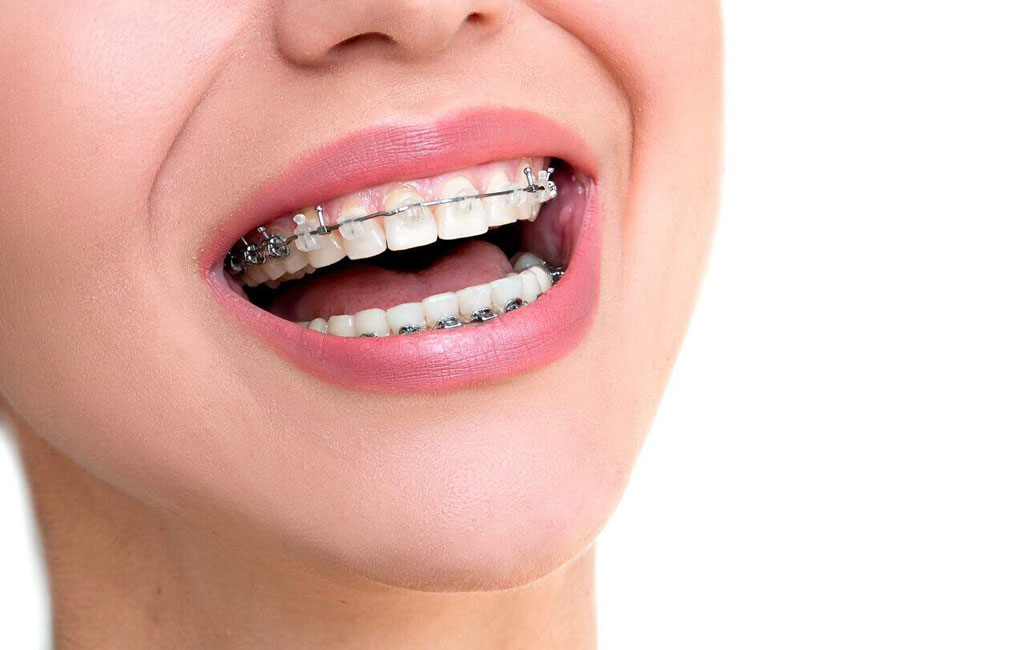 ازتودنسی سرامیکی با سایر روش های ارتودنسی مثل براکت فلزی و شفاف چه تفاوت هایی دارد؟