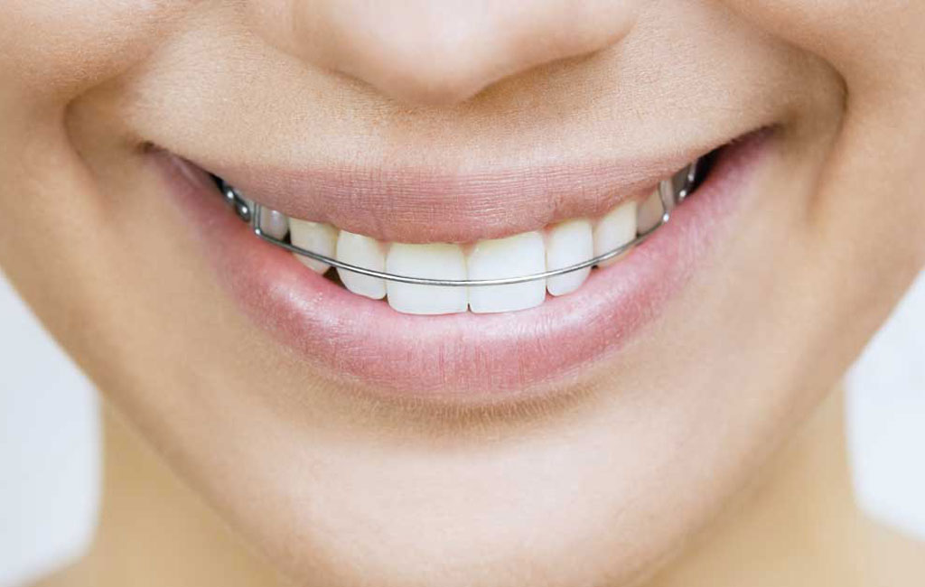هزینه تقریبی و مدت زمان استفاده از ریتینر چه قدر است؟